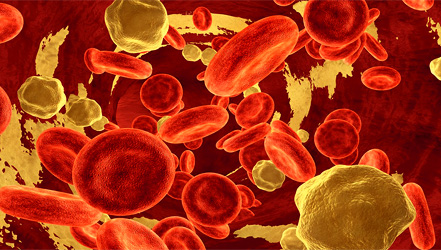 Cholesterolové plaky v krvných cievach.