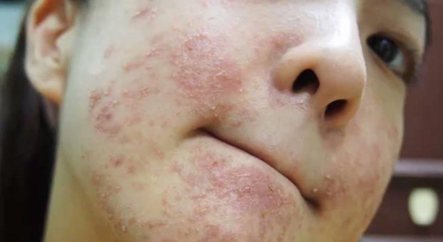 Bagaimana alergi madu memanifestasikan dirinya dan apa saja gejalanya?