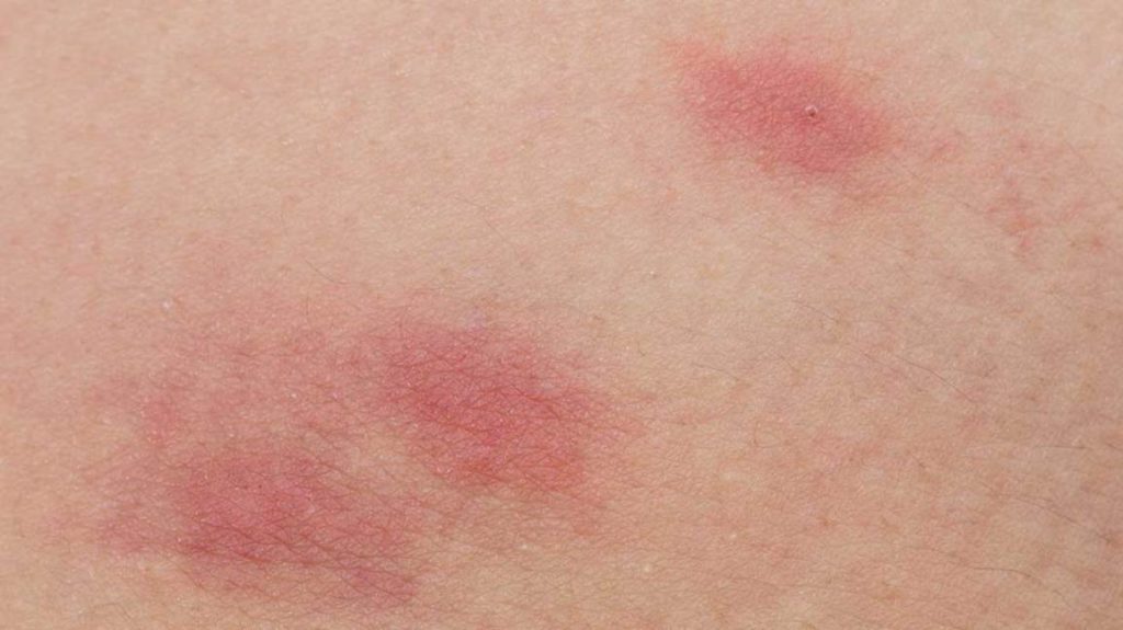Bagaimana alergi madu memanifestasikan dirinya dan apa saja gejalanya?