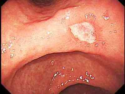 ブタの潰瘍の症状と治療