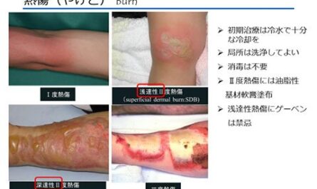 皮膚の違反のための蜂蜜：傷、栄養性潰瘍、火傷