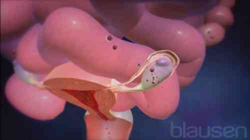젖소의 자궁 내막증이란 무엇입니까?