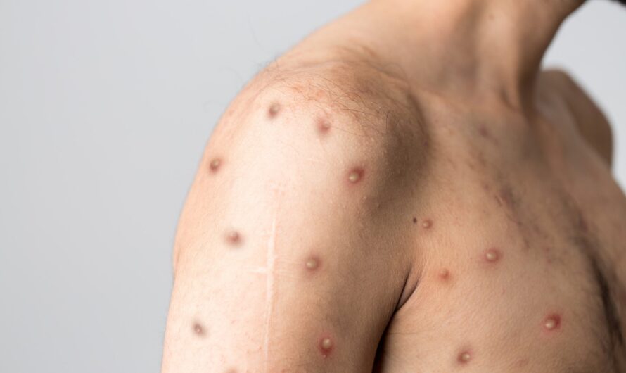 O que é varíola, sintomas de doença e opções de tratamento