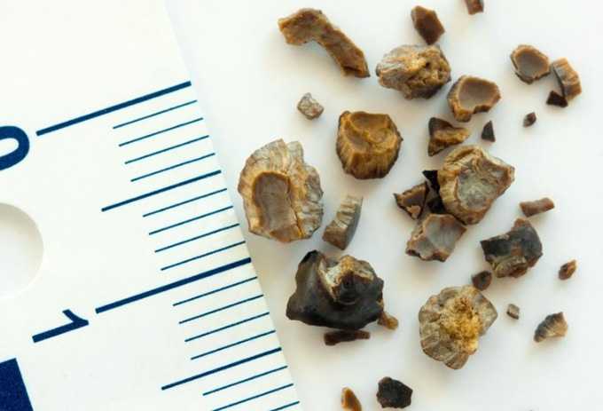 Cum să vindeci nisipul pentru rinichi cu miere –